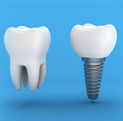 All You Need to Know about Full Mouth Dental Implants