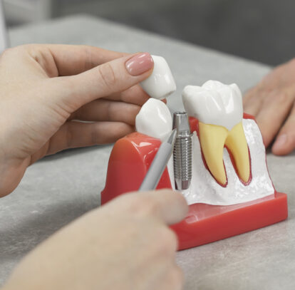 Types of Endosteal Implants: Which Is Right for You?