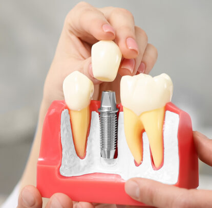 Dental Implant Crowns: Process, Types, and Aftercare