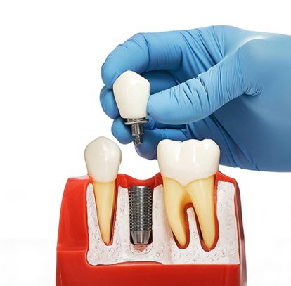 Are You a Candidate for Dental Implants? Here’s How to Tell