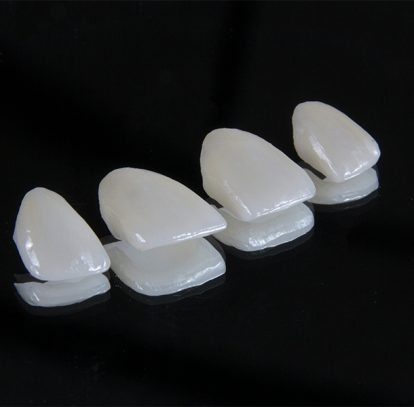 How Long Do Veneers Last? A Realistic Look at Durability