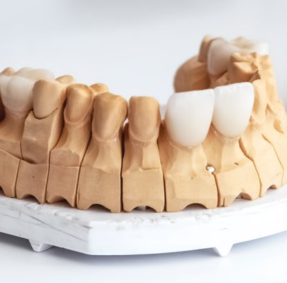 Do Veneers Damage Your Teeth? Myths vs Reality